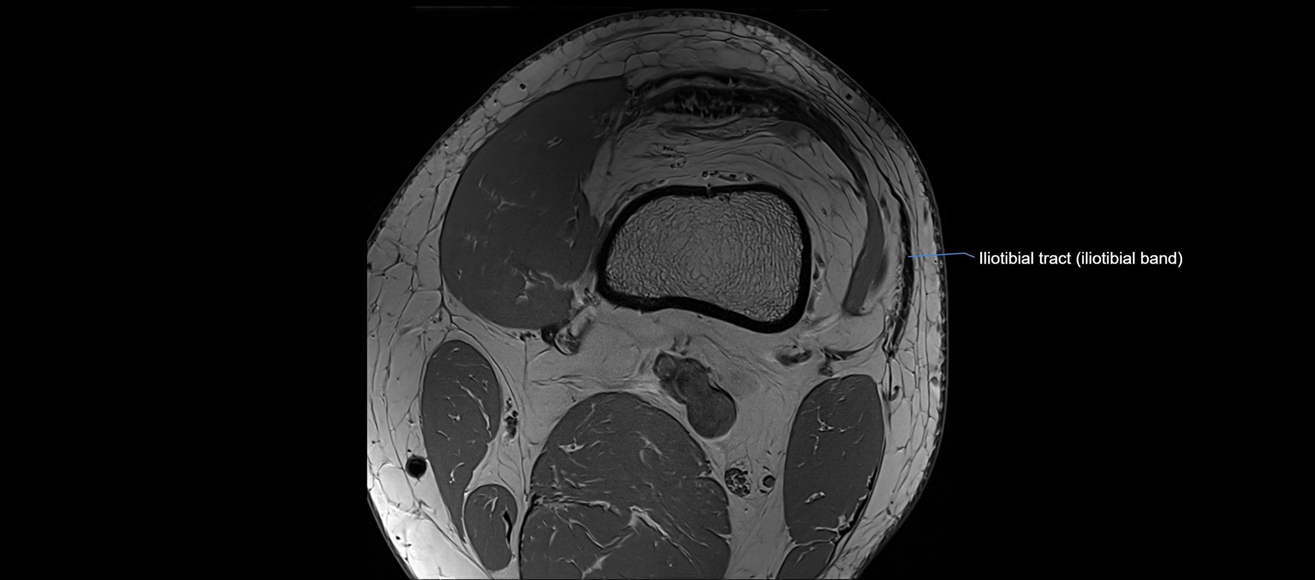 MRI Knee axial  ligaments cross sectional anatomy 3T  radiology  image-img-03001-00004.webp